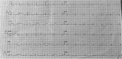 Case Report: Flurbiprofen-induced Type I Kounis syndrome